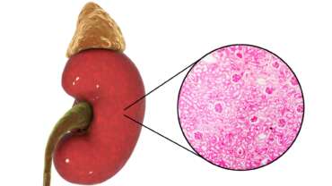 Post-Streptococcal Glomerulonephritis – Causes, Symptoms and Treatment