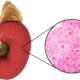 Post-streptococcal glomerulonephritis, a rare kidney disease causing inflammation in the glomeruli (filtration units).
