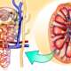 medical illustration of nephrotic syndrome, a kidney disorder causing the body to excrete excessive protein in urine