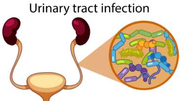 Urinary Tract Infections – Causes, Symptoms, and Effective Management