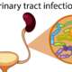 medical illustration of human urinary tract infection