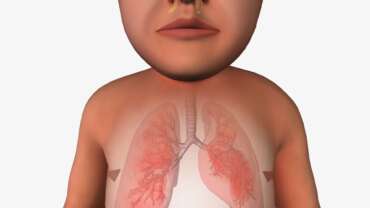 Cystic Fibrosis Symptoms and Treatment – Key Signs, Diagnosis & Breakthroughs