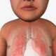 Cystic fibrosis (CF) is an inherited, life-shortening genetic disorder caused by a defective CFTR gene, which produces thick, sticky mucus that clogs lungs, damages the pancreas, and causes severe respiratory and digestive dysfunction