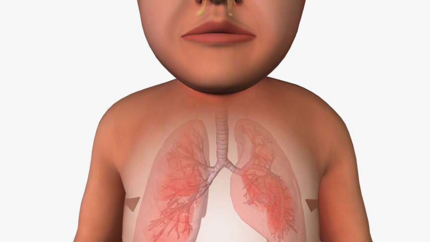 Cystic fibrosis (CF) is an inherited, life-shortening genetic disorder caused by a defective CFTR gene, which produces thick, sticky mucus that clogs lungs, damages the pancreas, and causes severe respiratory and digestive dysfunction