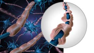 Multiple Sclerosis Symptoms and Treatment Guide