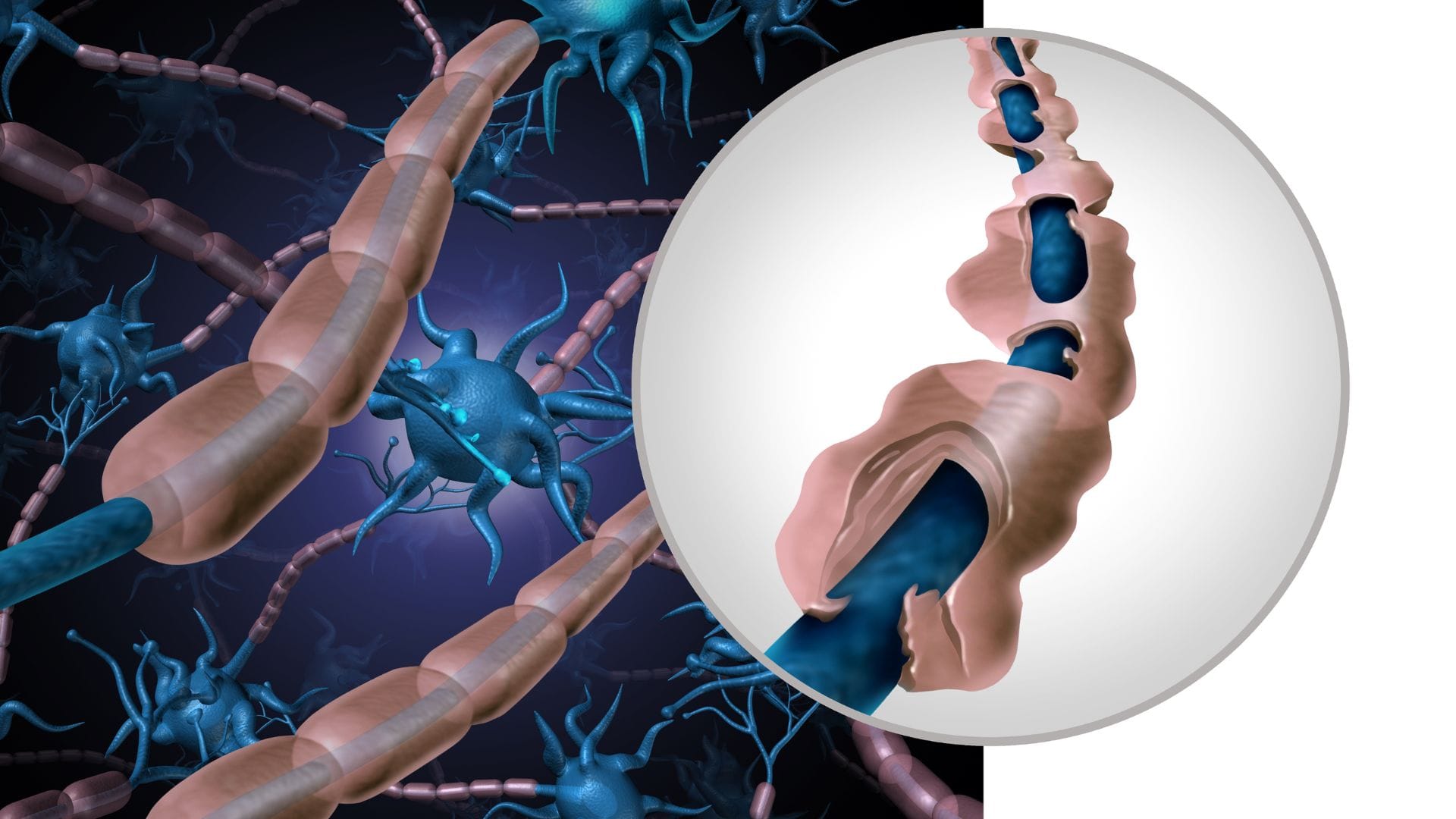 multiple sclerosis symptoms and treatment — immune system attacking myelin sheath in the brain