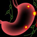 Heartburn in the stomach illustration representing management of gerd