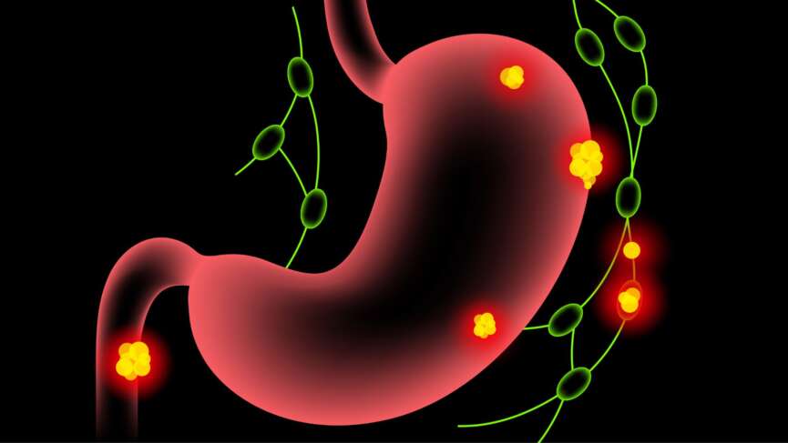 Heartburn in the stomach illustration representing management of gerd
