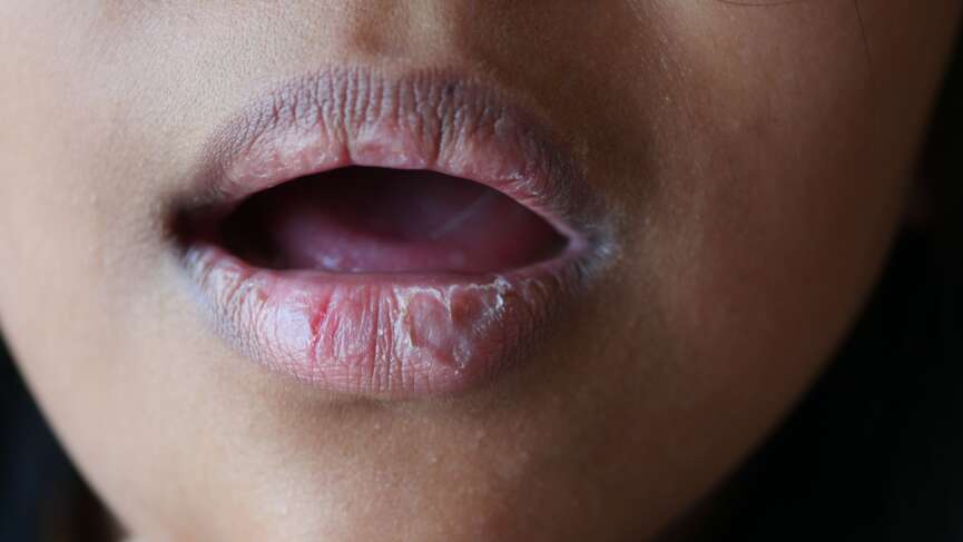a close-up shot with chapped and sore lips