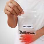a young man holding a gallstones in small plastic bag representing the causes of gallstones
