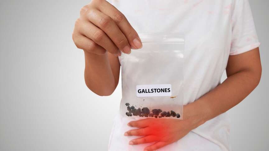 a young man holding a gallstones in small plastic bag representing the causes of gallstones