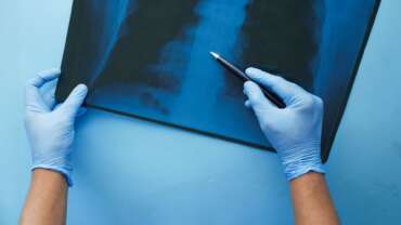 A Male doctor examines an x-ray of lungs in hospital and how asthma is affecting them