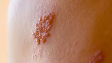 herpes zoster (varicella-zoster virus) skin rash and blisters on body representing warning signs of herpes