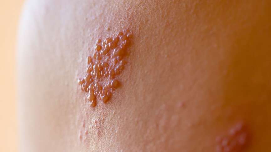 herpes zoster (varicella-zoster virus) skin rash and blisters on body representing warning signs of herpes