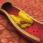 cardiovascular disease characterized by the gradual buildup of plaque in artery walls, representing clogged arteries in legs