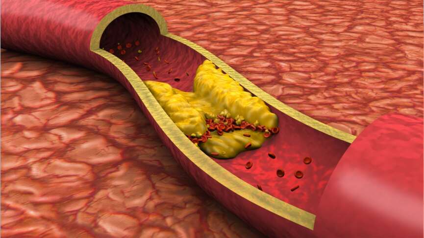 cardiovascular disease characterized by the gradual buildup of plaque in artery walls, representing clogged arteries in legs