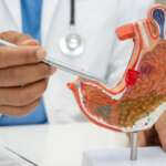 doctor holding anatomy model for study, diagnosis, and treatment in a hospital representing stomach ulcer symptoms