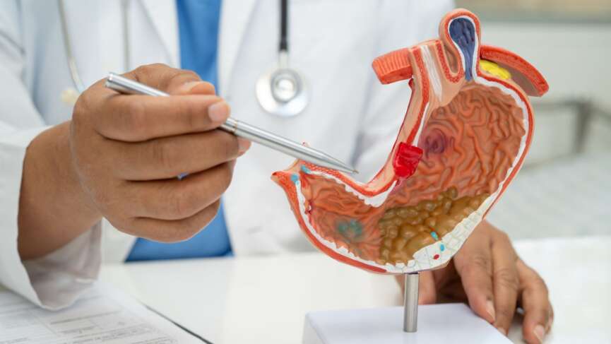 doctor holding anatomy model for study, diagnosis, and treatment in a hospital representing stomach ulcer symptoms