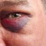 a close-up shot of a man with the black under-eye area concept, representing black-eye treatment
