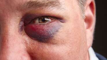 a close-up shot of a man with the black under-eye area concept, representing black-eye treatment