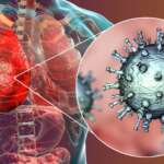 pneumonia medical concept 3d illustration showing bacteria, Streptococcus pneumoniae, in human lungs, representing the causes of pneumonia