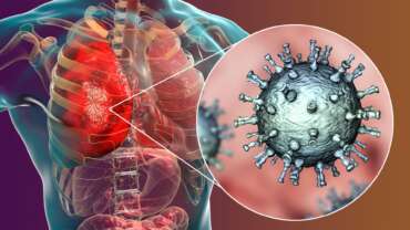 pneumonia medical concept 3d illustration showing bacteria, Streptococcus pneumoniae, in human lungs, representing the causes of pneumonia