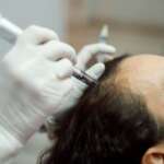 Woman scalp microneedling and injection treatment for hair growth stimulation in clinic