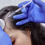 doctor injecting prp treatment to female hair loss patient through syringe for hair loss