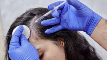 doctor injecting prp treatment to female hair loss patient through syringe for hair loss