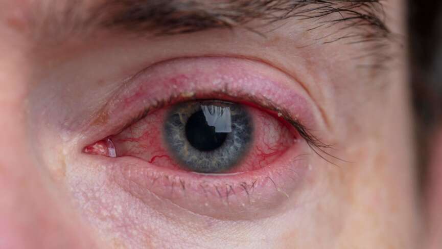 Close-up of one annoyed red-blooded and health eye of female affected by dry eyes representing causes of dry eyes
