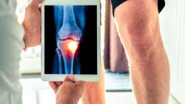 A doctor holds and examines an x-ray picture of the patient's leg bones for the diagnosis of osteoarthritis