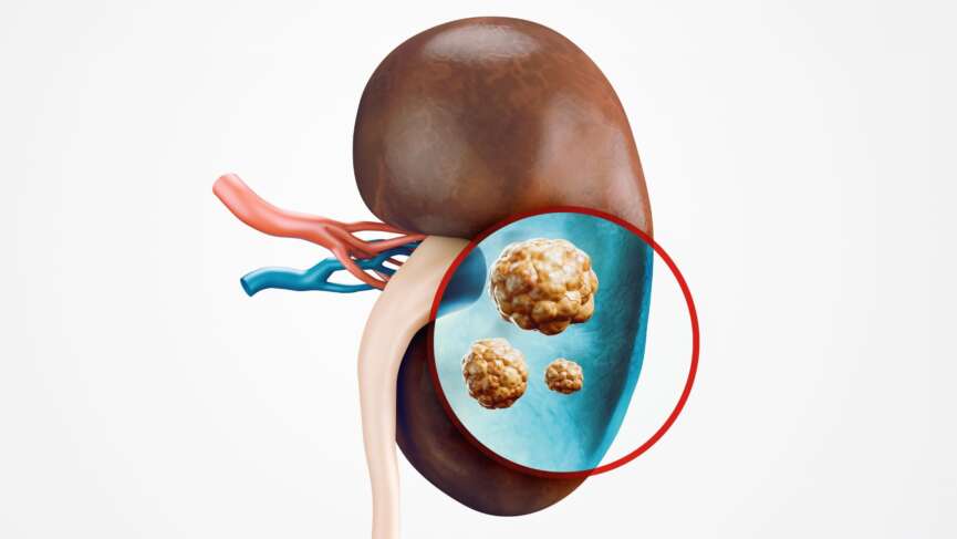 Anatomy of a realistic 3D illustration of the human internal organ kidney, presenting the kidney stones and preventing it