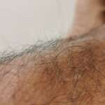 A close-up shot of a excess body hair caused by hirsutism