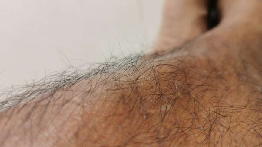 A close-up shot of a excess body hair caused by hirsutism