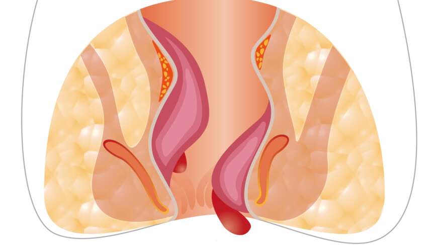 Medical infographic with diseases of the anus, hemorrhoids, and symptoms of anal fistula
