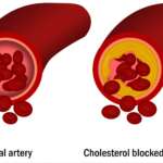 medical illustration with a normal artery and cholesterol-blocked artery as the signs of high cholesterol symptoms