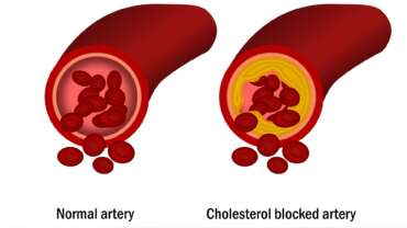 medical illustration with a normal artery and cholesterol-blocked artery as the signs of high cholesterol symptoms