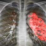 infected lungs in medical illustration as the signs of pneumonia
