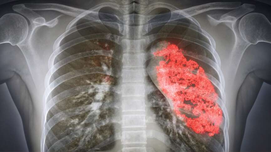 infected lungs in medical illustration as the signs of pneumonia