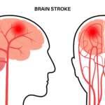 medical infographic representing the symptoms of brain stroke