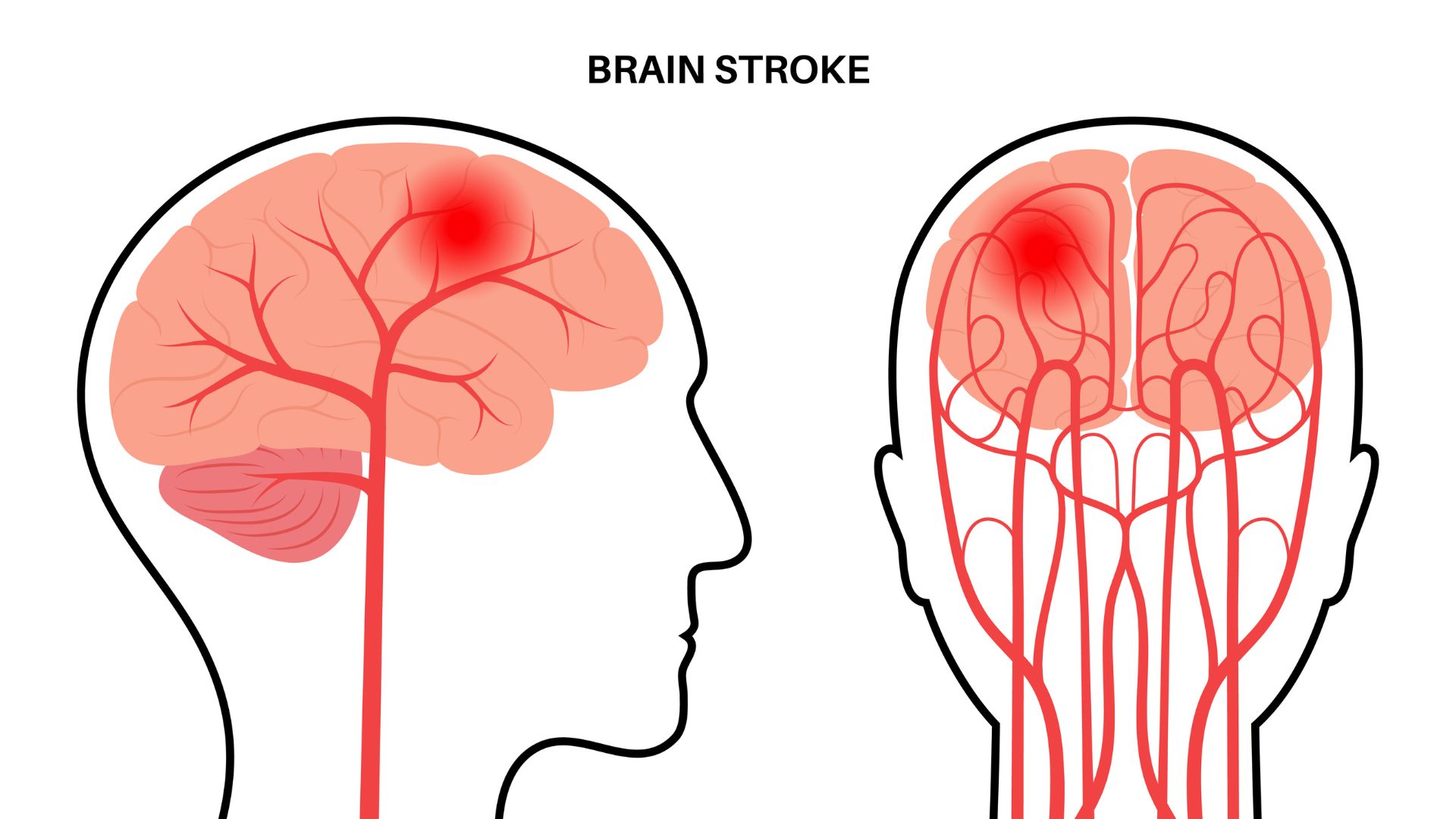 medical infographic representing the symptoms of brain stroke