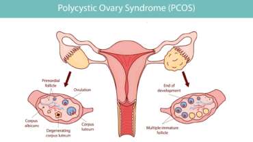 Polycystic ovary syndrome (PCOS), ovarian cysts of the female reproductive system and health risks associated with PCOS