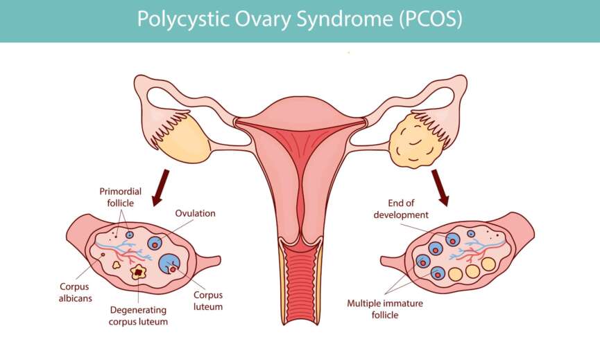 Polycystic ovary syndrome (PCOS), ovarian cysts of the female reproductive system and health risks associated with PCOS
