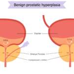 Diagram showing benign prostatic hyperplasia (BPH) where an enlarged prostate compresses the urethra and obstructs urine flow from the bladder.