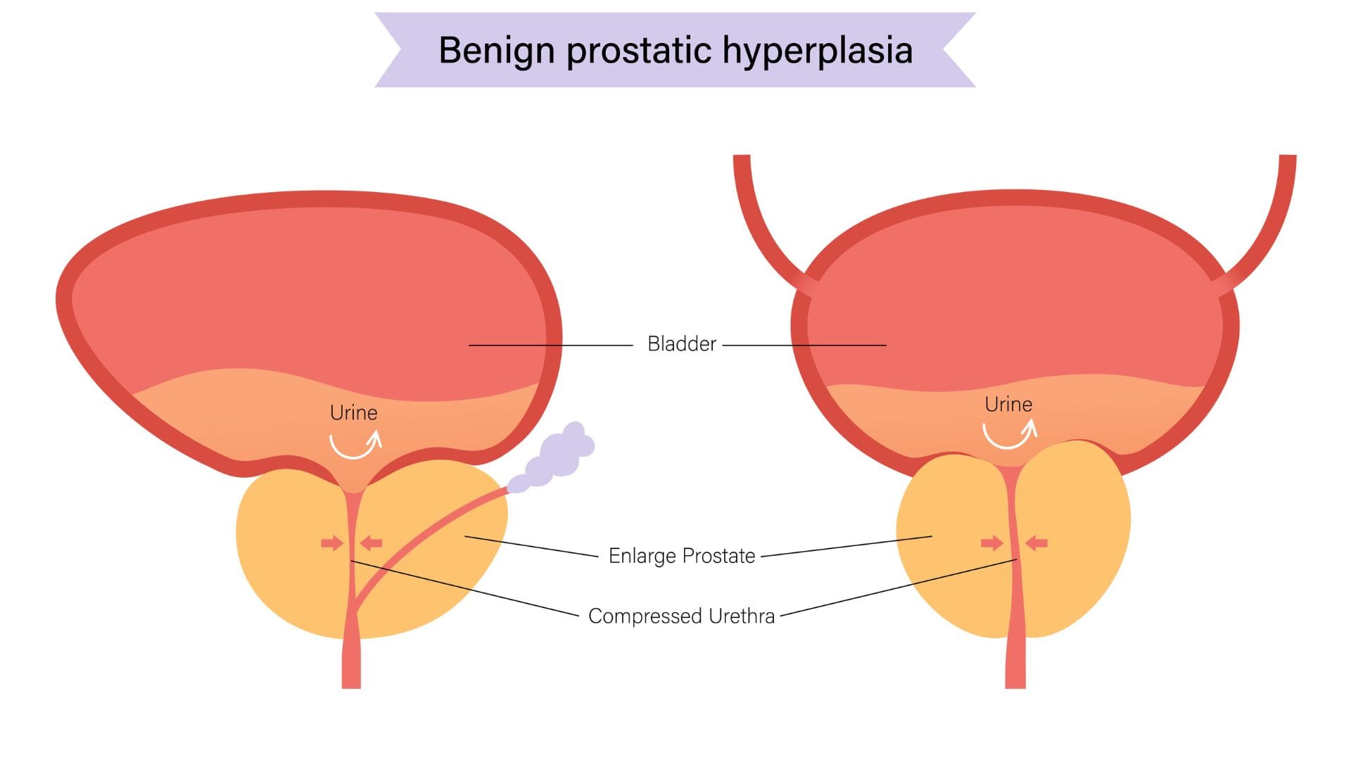 Diagram showing benign prostatic hyperplasia (BPH) where an enlarged prostate compresses the urethra and obstructs urine flow from the bladder.