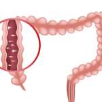 infection of intestine showing the causes of ulcerative colitis