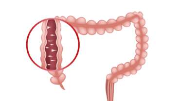 infection of intestine showing the causes of ulcerative colitis