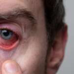 The doctor looks at male patient with red, inflamed eyes with Graves' disease symptoms