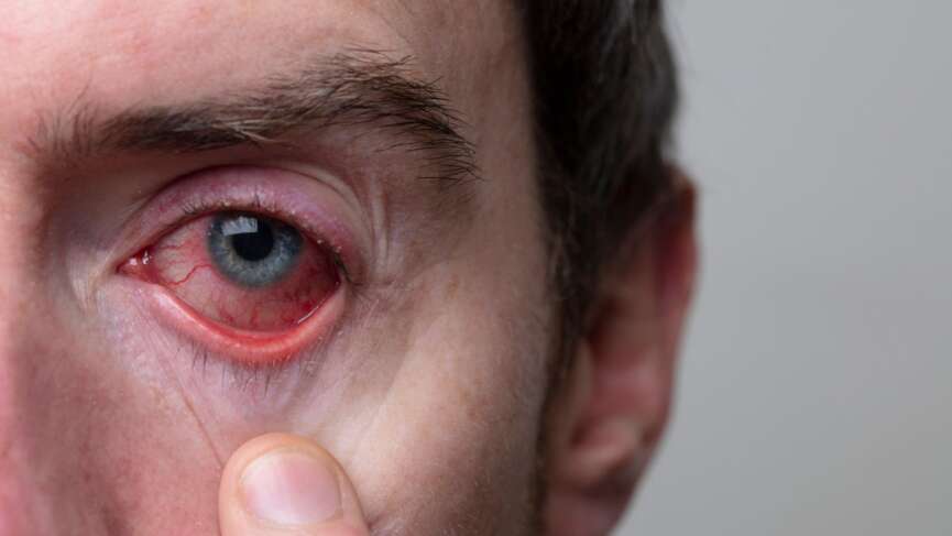 The doctor looks at male patient with red, inflamed eyes with Graves' disease symptoms