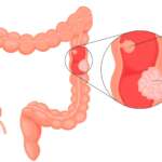 Colorectal cancer (crc) infographic for education presenting the factors affecting colon cancer